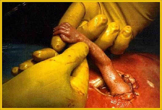 la manina del feto chiamato Samuel