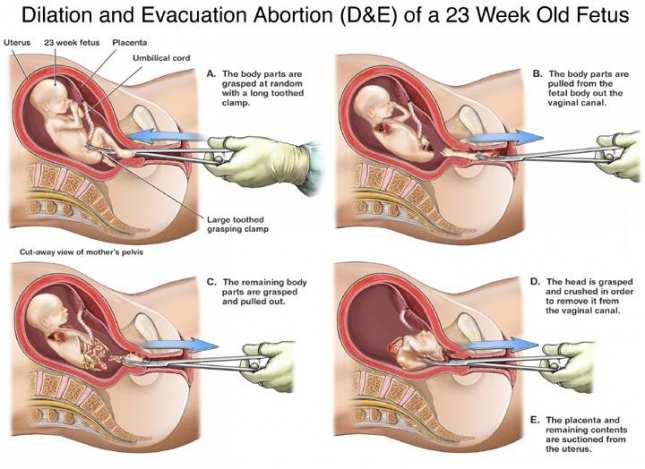 aborto_dilatazione_estrazione