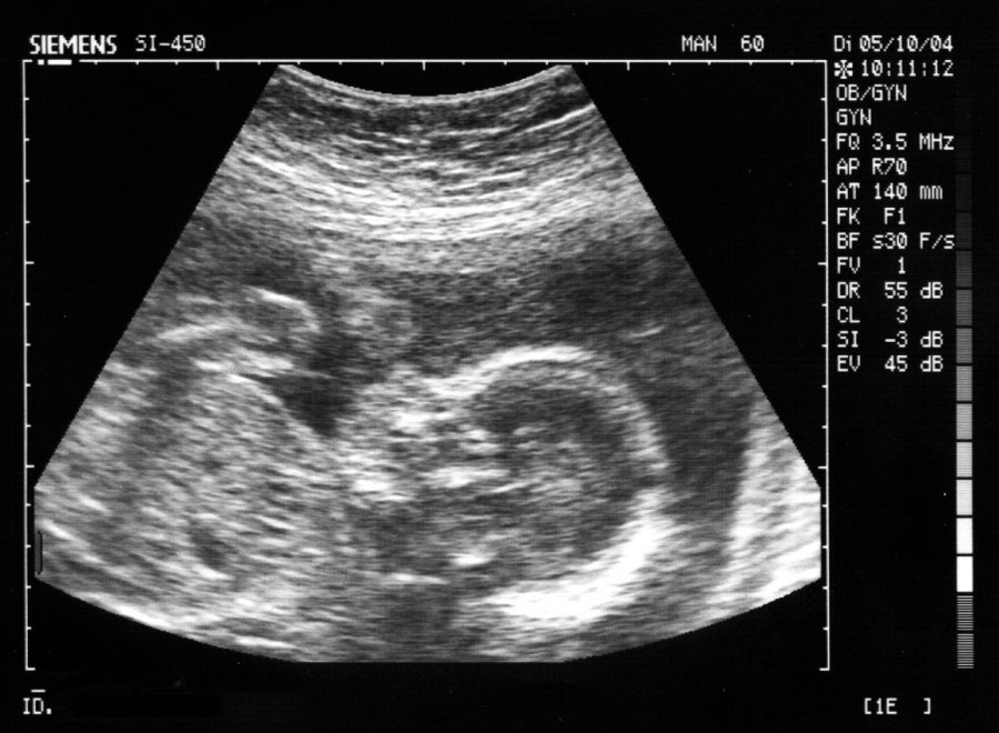 feto_terapia fetale_medicina fetale_Buona-Notizia